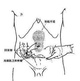 阑尾炎症状疼痛位置图片